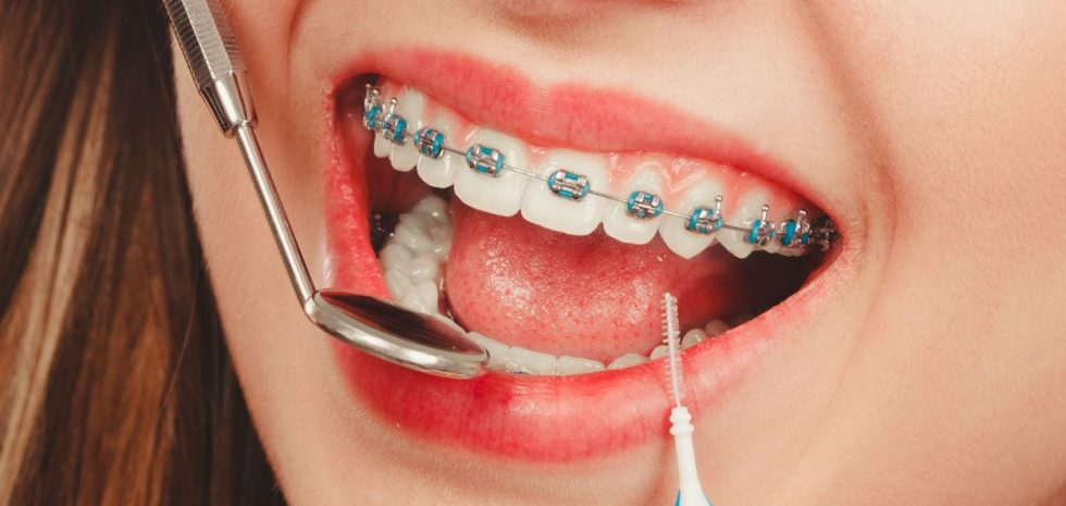 Aparat ortodontyczny ruchomy